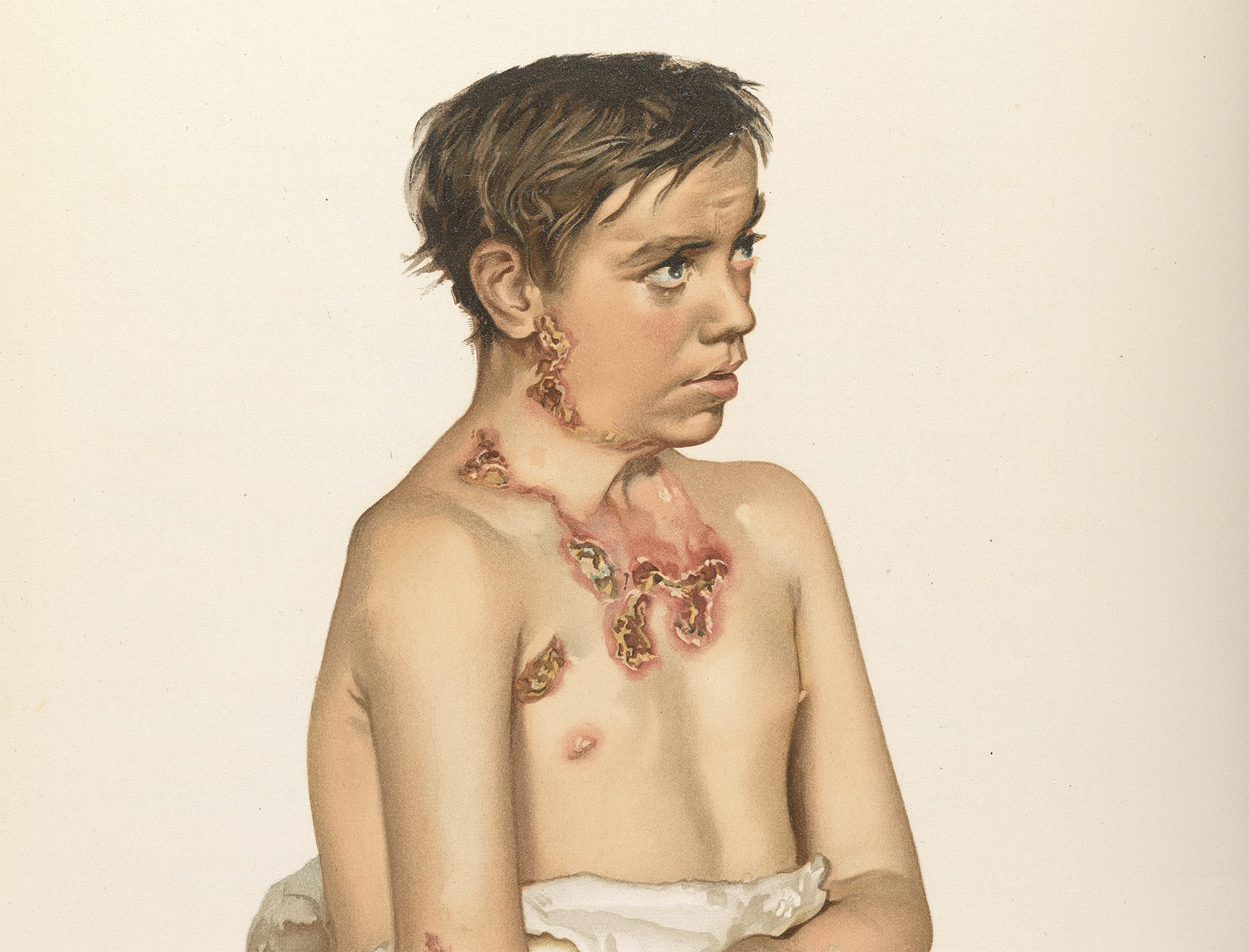 'A young man with scrofula', Atlas of Clinical Medicine, 1892-96.