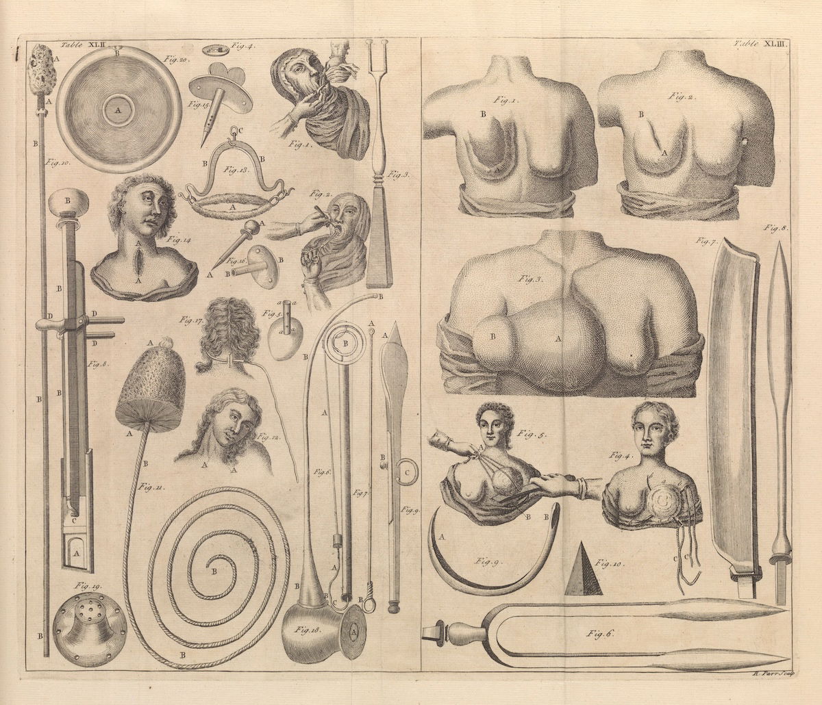 Plate by Remi Parr showing a cancerous breast and mastectomy, from R. James’ A medicinal dictionary, including physic, surgery, anatomy, chymistry, and botany in all their branches relative to medicine, c.1745.  Wellcome Collection. Public Domain.
