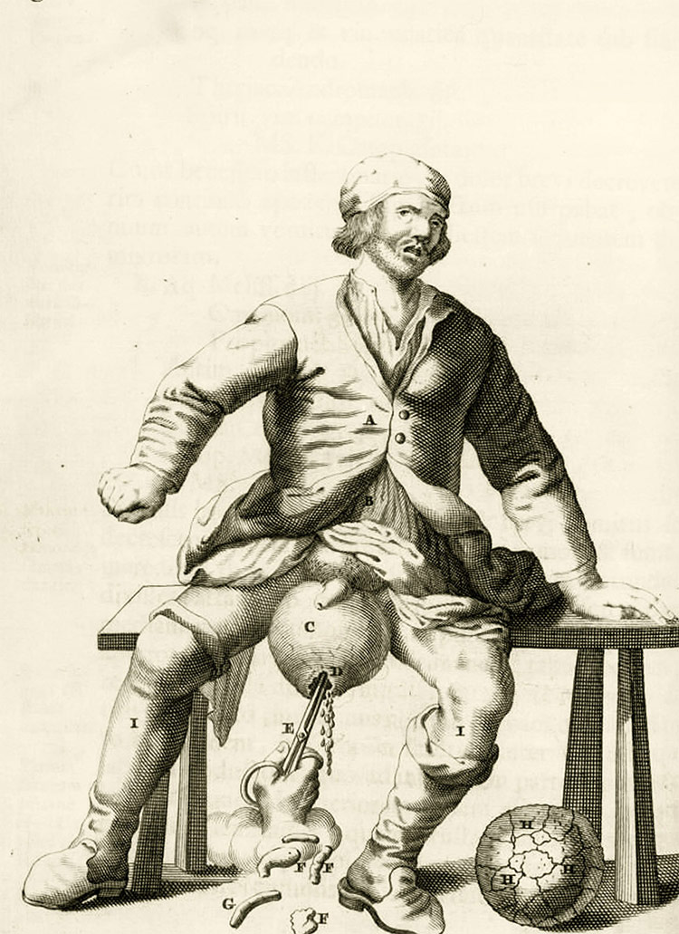 Private pain: draining fluid from a hydrocele of the scrotum. Engraving by Frederik Dekkers. Dutch, 1694.