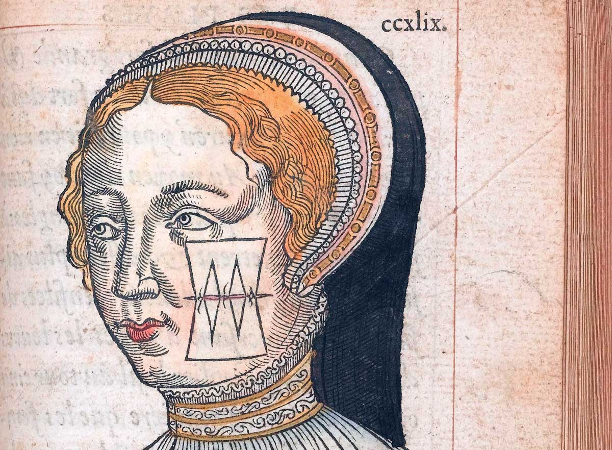 A face with a stitched cheek, from La méthode curative des playes, et fractures de la teste humaine, by Ambroise Paré, 1561.