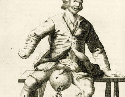 Private pain: draining fluid from a hydrocele of the scrotum. Engraving by Frederik Dekkers. Dutch, 1694.